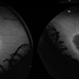 Usher's Syndrome Usher's Syndrome