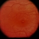 Sturge-Weber / Choroidal Hemangioma Sturge-Weber / Choroidal Hemangioma