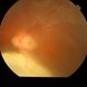 Choroidal Coloboma With Retinal Detachment Choroidal Coloboma With Retinal Detachment