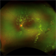Coats' Disease - Widefield Fundus Image Coats' Disease - Widefield Fundus Image