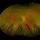Posterior Scleral Laceration