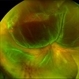 Retinal Detachment with multiple breaks Retinal Detachment with multiple breaks