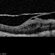 Vitreoschisis Vitreoschisis