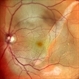 RPE rip in a case of Idiopathic polypoidal choroidopathy