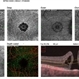 Full Thickness Macular Hole Full Thickness Macular Hole