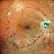 PROLIFERATIVE DIABETIC RETINOPATHY PROLIFERATIVE DIABETIC RETINOPATHY