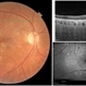 Hypertensive Choroidopathy - Right Eye