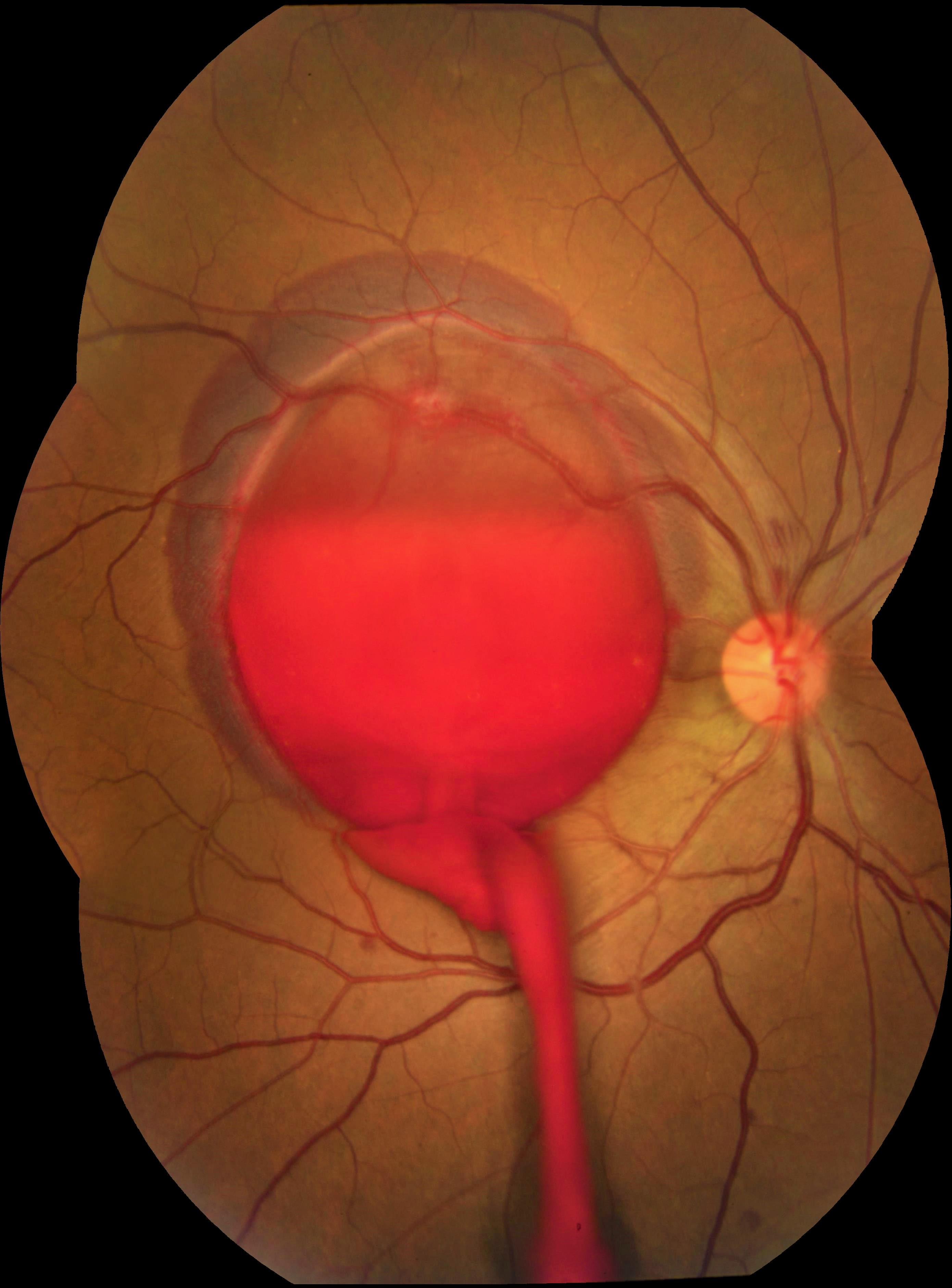 retina image retina image