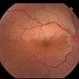 Branch Retinal Artery Occlusion Branch Retinal Artery Occlusion