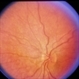 Leber's Congenital Amaurosis