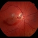 Partial Optic Disc Avulsion with Optic Disc Pit Partial Optic Disc Avulsion with Optic Disc Pit