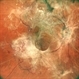 TRACTIONAL RETINAL DETACHMENT TRACTIONAL RETINAL DETACHMENT
