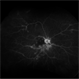 Chorioretinal Inflammation Chorioretinal Inflammation