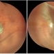 Giant Retinal Tear with Retina Detachment, Both Eyes Giant Retinal Tear with Retina Detachment, Both Eyes