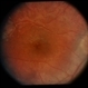 CGD / Chronic Granulomatous Disease