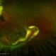 Familial Exsudative Vitreoretinopathy (FEVR)