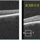 Macular Hole Observed