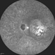 Macular Coloboma and Pigmentary Retinopathy Macular Coloboma and Pigmentary Retinopathy