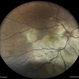 Exudative Retinal Detachment