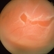 Retinal Tear with Detachment