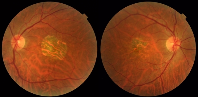 Central Areolar Choroidal Dystrophy - Retina Image Bank