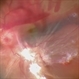 Retinal Detachment With Vitreous Hemorrhage With Sub Retinal Bleed With PVR Changes
