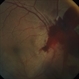 Traumatic optic nerve avulsion Traumatic optic nerve avulsion