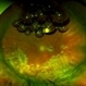 Pseudophakic RRD, S/P Buckle/Vit. w/ Residual Gas Fish Eggs OD Pseudophakic RRD, S/P Buckle/Vit. w/ Residual Gas Fish Eggs OD