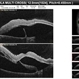 RPE rip in a case of Idiopathic polypoidal choroidopathy