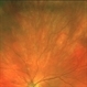 Varix of Vortex Vein - Optos, Immediately Looking Supero-Nasally Varix of Vortex Vein - Optos, Immediately Looking Supero-Nasally