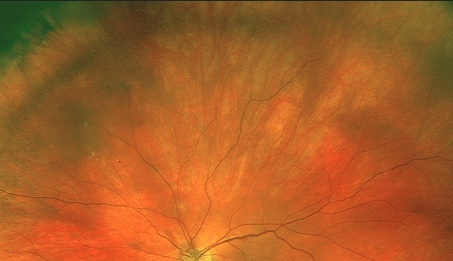 Varix of Vortex Vein - Optos, Immediately Looking Supero-Nasally ...