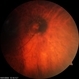 Optic Disc Melanocytoma Optic Disc Melanocytoma