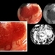Papilloma Conjunctiva Papilloma Conjunctiva