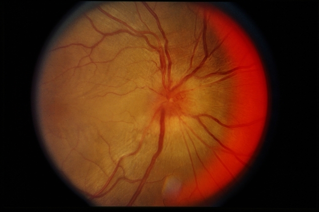 Vogt-Koyanagi-Harada Disease - Retina Image Bank