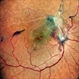 Old Supero-Temporal Branch Retinal Vein Occlusion with Macular Hole Right Eye Fundus Old Supero-Temporal Branch Retinal Vein Occlusion with Macular Hole Right Eye Fundus