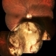 Retinochoroidal Coloboma With Aberrant Vasculature Retinochoroidal Coloboma With Aberrant Vasculature