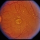 ARMD / Subfoveal CNVM ARMD / Subfoveal CNVM