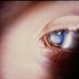 Myotonic Dystrophy