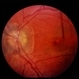 Pseudotumor Cerebri Pseudotumor Cerebri