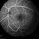Retinal Dystrophy of 24-Year-Old Male/ Fluorescein Angiogram OS Retinal Dystrophy of 24-Year-Old Male/ Fluorescein Angiogram OS