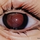 Retrolental Bullous Retinal Detachment Retrolental Bullous Retinal Detachment