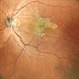 Epiretinal Membrane Epiretinal Membrane