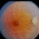 Hyperlipidemia