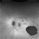 Congenital Hypertrophy of the Retinal Pigment Epithelium Autofluorescence Optomap Congenital Hypertrophy of the Retinal Pigment Epithelium Autofluorescence Optomap