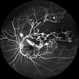 Branch Retinal Vein Occlusion Branch Retinal Vein Occlusion