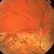 Pseudo Retinitis Pigmentosa Pseudo Retinitis Pigmentosa