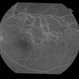BRVO With Non-perfusion