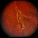 CGD / Chronic Granulomatous Disease