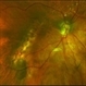 Tilted Disc Syndrome Complicated with RPE Atrophy and Polypoidal Choroidal Vasculopathy Tilted Disc Syndrome Complicated with RPE Atrophy and Polypoidal Choroidal Vasculopathy