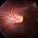 Macular Dragging Macular Dragging